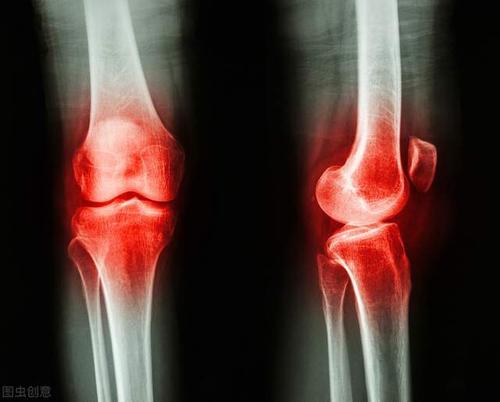 非遗老张家膏贴：膝盖积水与滑膜炎有什么关联 膝盖积水